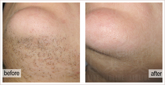 QOOL epilation